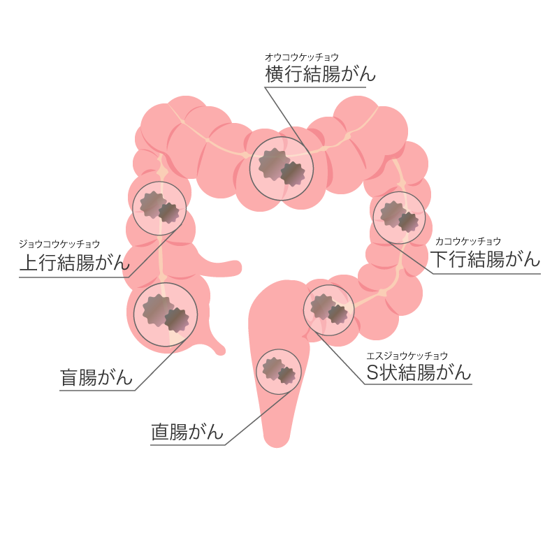 大腸がんとは