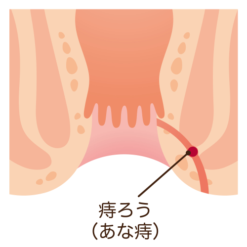 痔ろう（穴痔）