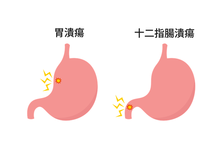 胃潰瘍・十二指腸潰瘍とは